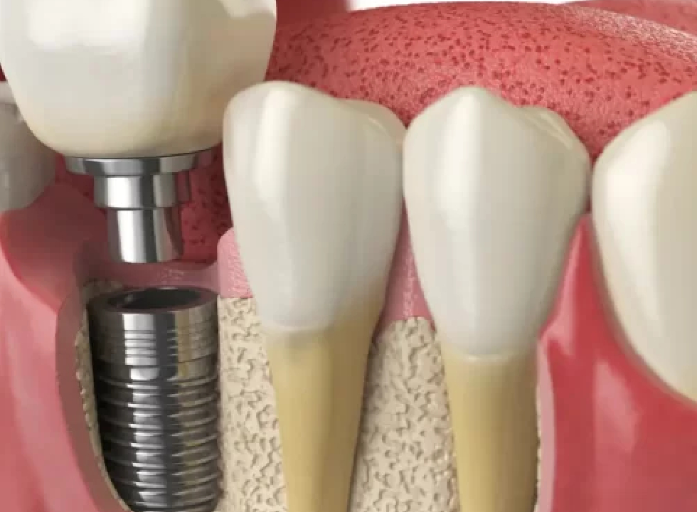 The Recovery Process After Dental Implant Surgery